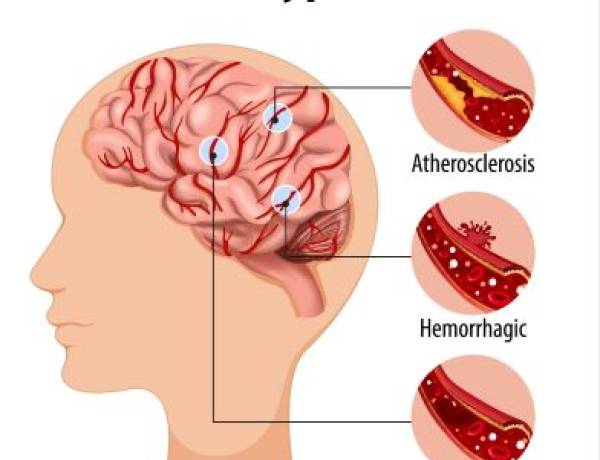 Pentingnya Penurunan Kolesterol Jahat Secara Berkelanjutan, Cegah Serangan Jantung & Stroke